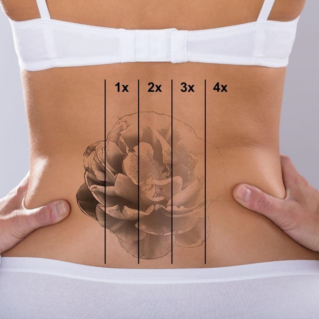 before and after tattoo removal
